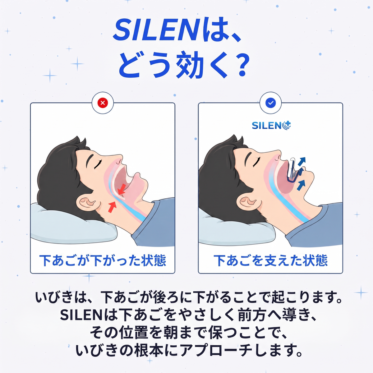 SILENいびき防止マウスピース
